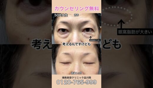 50代女性 症例解説です。クマ取りたるみ取り美容整形 予約は☎️0120489100 #美容整形#目の下のたるみ#目の下のくま#くまとり#クマ取り#目の下のクマ#shorts