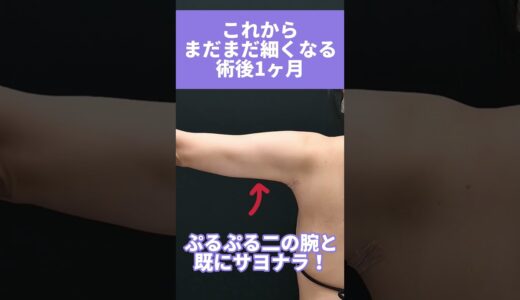 振袖肉を脂肪吸引するとどうなる？#shorts #美容整形