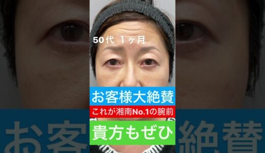 50代に奇跡を起こすクマ取りたるみ取り美容整形 予約は☎️0120489100 #美容整形#目の下のたるみ#目の下のくま#くまとり#クマ取り#目の下のクマ#shorts