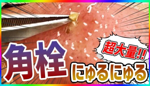 【角栓除去】超大量の”鼻の角栓”をにゅるにゅる圧出！【ブラックヘッド/ニキビ】／Blackhead Removal Show