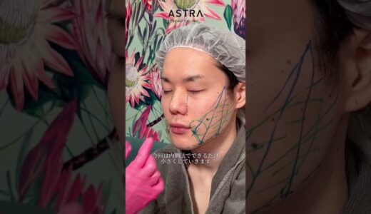 【鼻を小さく顔も小さく👃☺️】#美容整形#鼻整形#アストラビューティークリニック #astrabeautyclinic