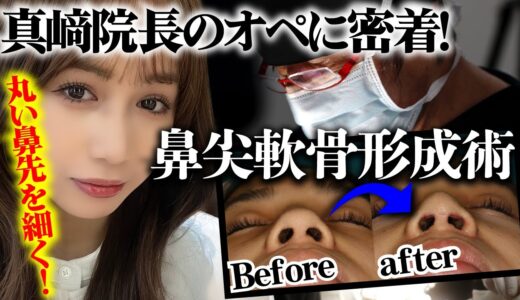 【鼻尖軟骨形成手術】23歳女性、初めて美容整形をしました。コンプレックスをなくし、自分をもっと好きになる方法。