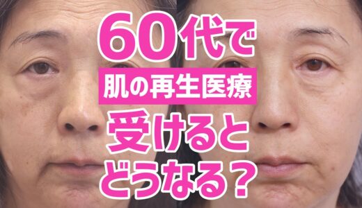 整形しないアンチエイジング美容医療「肌の再生医療」ビフォーアフター｜60代 女性｜6ヶ月検診