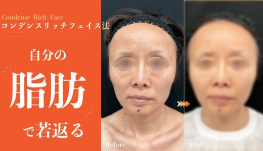 【美容整形】脂肪注入で女性らしいまん丸おでことたまご型フェイスラインで10歳若返り【湘南美容クリニック】