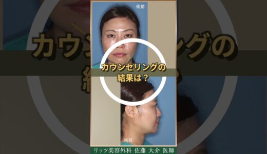 40代女性の美容整形、カウンセリング風景をお見せします！リッツ美容外科