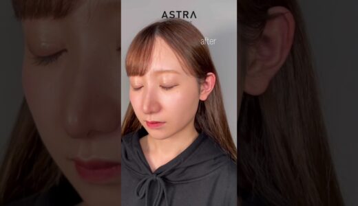 鼻の存在感をできるだけ無くしたい👃#美容整形 #鼻整形 #astrabeautyclinic