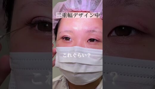 【二重整形】アイプチ地獄からの卒業 感動の二重整形　#shorts