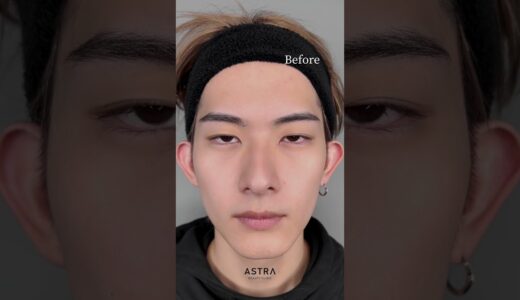 イケメンもやってる施術🤫❤︎ #美容整形 #メンズ美容 #astrabeautyclinic #二重整形