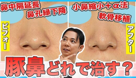 【鼻整形】豚鼻を治すにはどの美容整形を受けるべき？【鼻中隔延長・鼻孔縁下降・軟骨移植・小鼻縮小＋α法】