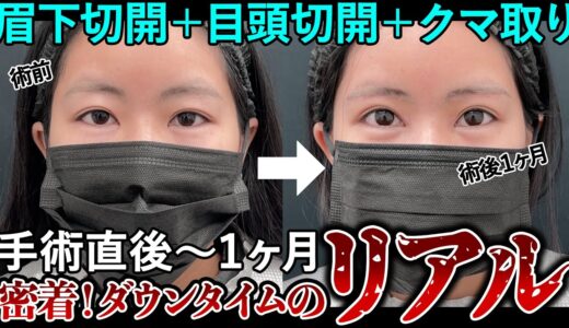 20代の美容カウンセラーがジェントル先生の手術を受けてみた。美容整形のリアル。