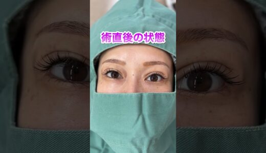 【二重整形】まぶたのたるみを解消する裏留め埋没方を大公開！