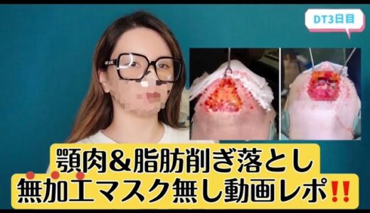 あご肉整形★ついに無加工マスク無しDT動画★解禁