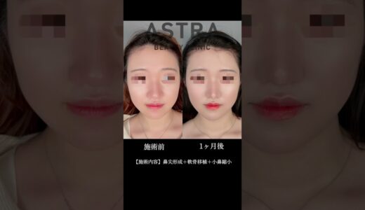 【鼻先が生まれ変わる】鼻整形解説👃 #鼻整形 #美容整形 #astrabeautyclinic #小鼻縮小