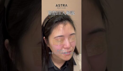 鼻整形解説👃大人顔→子供顔👶🏻#美容整形 #鼻整形 #astrabeautyclinic