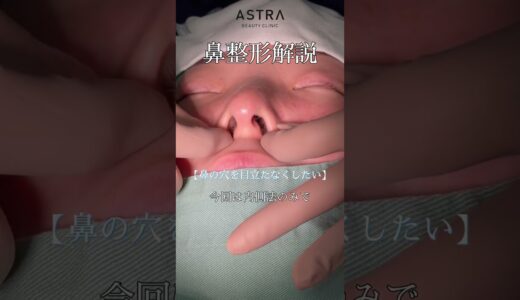 鼻フル整形！ダウンタイムが短くなる施術方法あります👃#美容整形 #astrabeautyclinic #鼻整形