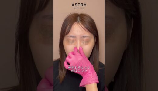 存在感のある高いお鼻👃#美容整形 #鼻整形 #astrabeautyclinic