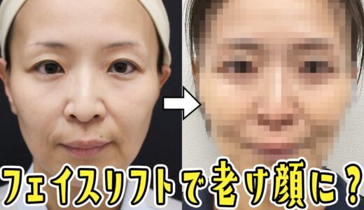 【フェイスリフトの落とし穴】”治療したのに老け顔”になるって本当！？