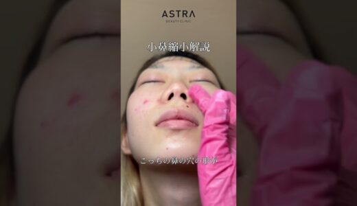 美鼻に生まれ変わります👃#美容整形 #鼻整形 #astrabeautyclinic