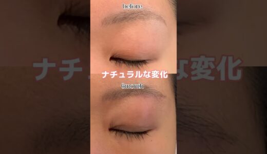 #眉下リフト #眉下切開 #美容整形 #眼瞼下垂 #目頭切開