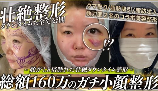 【整形】総額150万円超えの超小顔美容整形を密着 / ダウンタイムの様子も大公開【クマ取り・脂肪注入・脂肪吸引】#zetithbeautyclinic