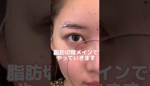 #眉下リフト #眉下切開 #ダウンタイム #美容整形