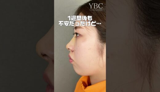 鼻整形したら不安になったけど【鼻尖形成】YBC横浜美容外科 #shorts