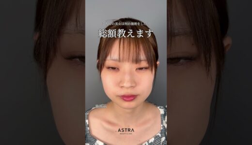 全顔フル整形美女✨ #美容整形 #鼻整形 #astrabeautyclinic #小鼻縮小 #小顔