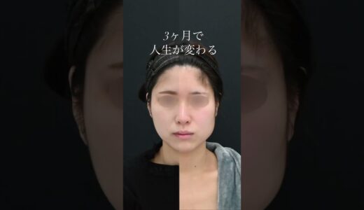 【整形】3ヶ月で人生が変わる輪郭整形 #shorts