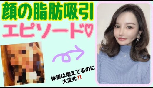 【美容整形】早くやれば良かった…🥹【顔脂肪吸引エピソード】