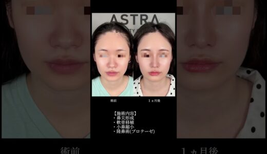 【オーダーメイド✨骨格似合わせ鼻整形】#美容整形 #astrabeautyclinic #鼻整形 #忘れ鼻 #アストラビューティクリニック #似合わせ整形 #オーダーメイド整形