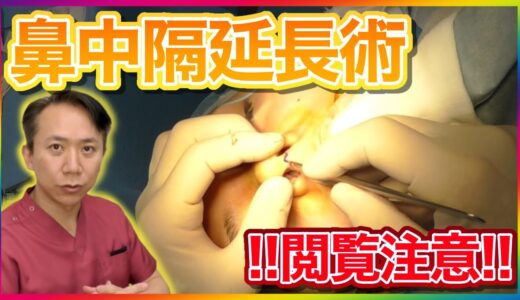 鼻中隔延長術の手術動画！【閲覧注意】鼻の整形を詳しく紹介☆★鼻整形・美容整形★☆