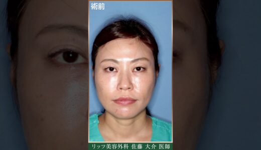 40代女性の美容整形、ビフォーアフターをお見せします！【目元・鼻・おでこ】