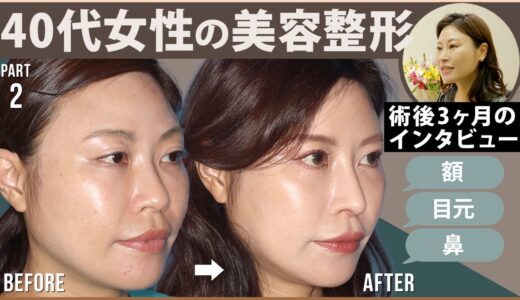 40代女性の美容整形！ビフォーアフタをお見せします！術後インタビュー②【リッツ美容外科】