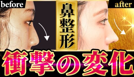 【鼻整形】モニター様の手術当日からダウンタイムに密着！