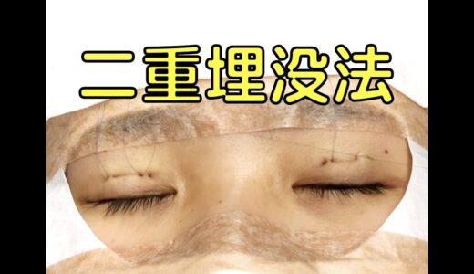 こだわりの埋没法二重手術【字幕をじっくり読んでください】Double Eyelid Surgery