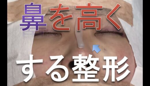 鼻プロテーゼ【閲覧注意】【手術動画】仙台　鼻整形（隆鼻術、鼻を高くする美容整形）Noselift with Silicone Implant