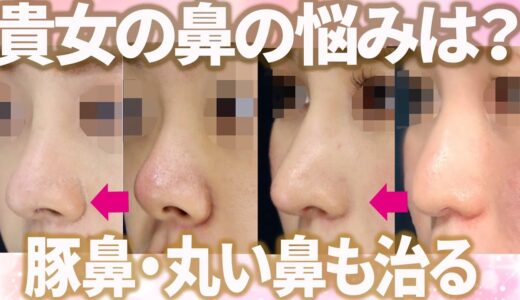 【鼻整形】様々な鼻に対応！あきらめていた鼻も理想の形に変身！ビフォーアフター紹介【湘南美容クリニック】