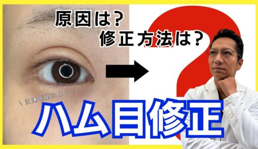 二重整形でハム目になる原因と修正方法：切開によるハム目修正