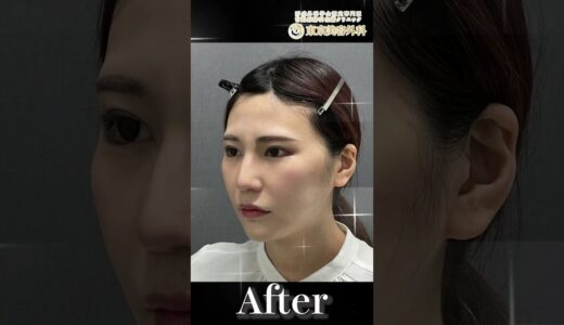 【小顔整形】美人すぎる整形後Before/after #整形 #お金持ちの息子の親父 #麻生泰 #東京美容外科 #Shorts