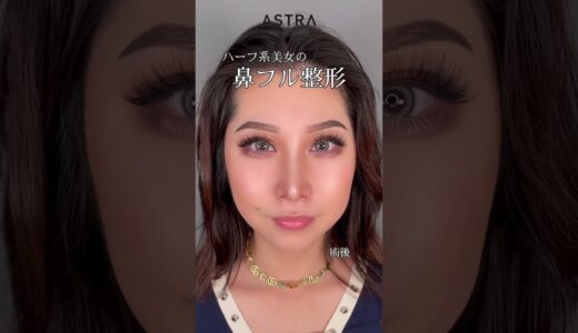 ハーフ系美女の鼻フル整形👃#美容整形 #鼻整形 #astrabeautyclinic