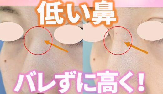 【鼻を高くする方法】オススメ鼻整形は自然で美しい仕上がり!ビフォーアフター紹介【形成外科専門医が解説】