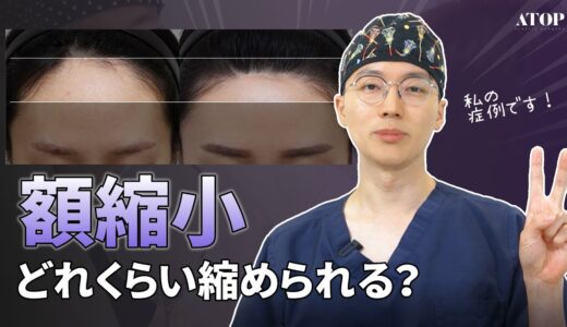 広い額の解決策！額縮小👍👍【エートップ美容整形外科】