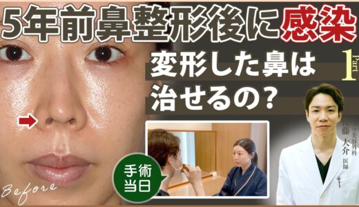 【30代女性の美容整形】鼻整形後に感染で鼻が変形してしまった方がご来院されました！手術当日の様子①【リッツ美容外科】