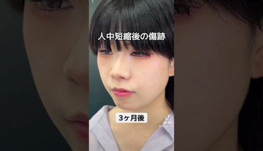 【美容整形】人中短縮の気になる施術後の傷跡　#shorts #美容整形 #人中短縮