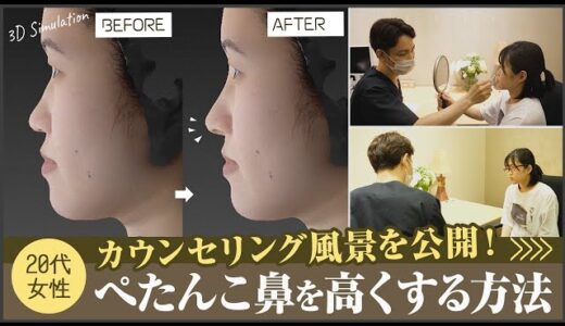 鼻が低い・ぺたんこ鼻を美容整形でどう治す？20代女性の鼻整形のカウンセリングをお見せします【リッツ美容外科】#鼻整形