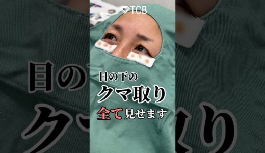 【クマ取り】40代女性💭勇気を出してクマ取り整形全てお見せします😊✨#shorts