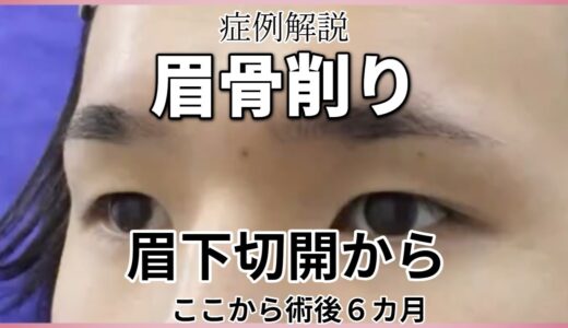 美容整形。眉毛下切開から眉骨削り。名古屋こいずみ形成クリニック