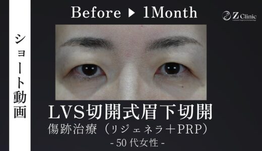 頭痛・肩こりが治る美容整形：50代女性、LVS切開式眉下切開＋傷跡治療（リジェネラ＋PRP）/１ Monthまで