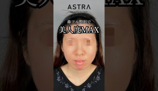 鼻フル整形で美人鼻👩🏼‍⚕️✨#アストラビューティクリニック#astrabeautyclinic #美容整形#鼻整形#忘れ鼻