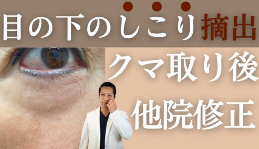 江連が好きな、他院修正：脂肪注入によるしこりを切らずに摘出/クマ取りの修正